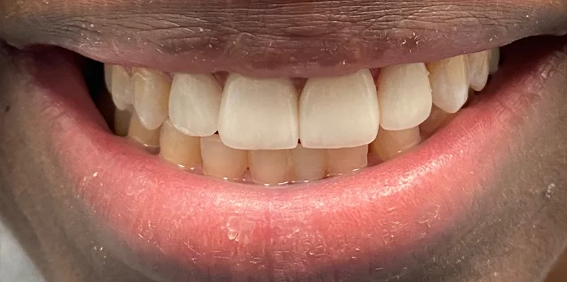 After dental treatment